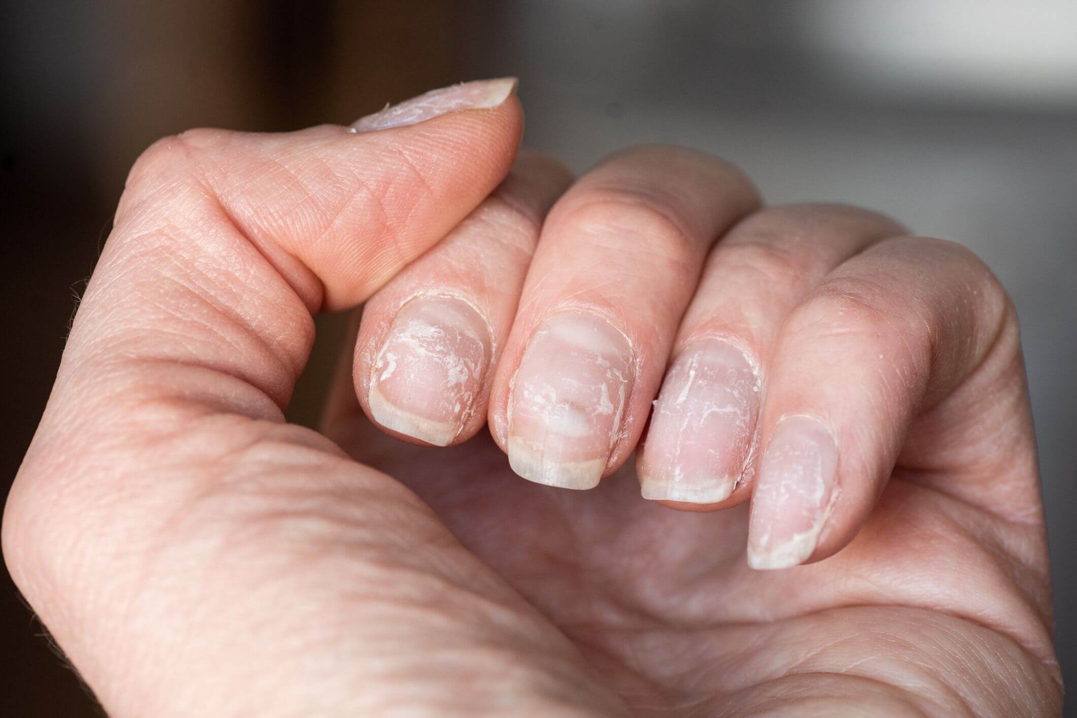 Natural Remedies to treat Brittle Nails!!