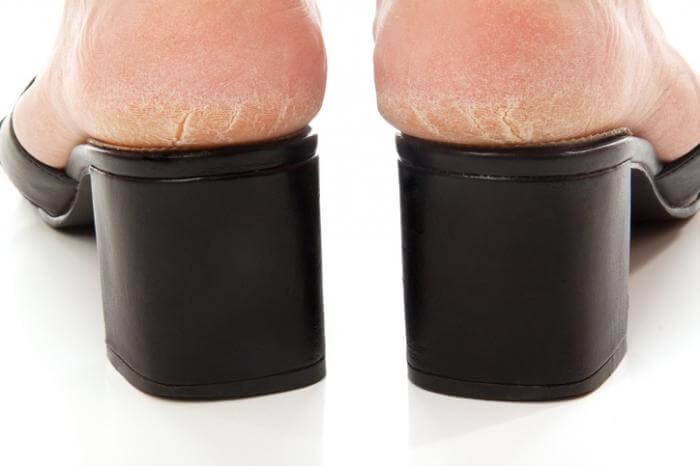 How to treat Cracked heels (Heel Fissures) at home!!