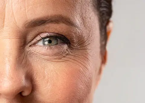 Treatment and prevention of Wrinkles (Rhytides) at Home !!