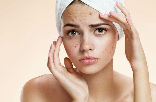 Home remedies to treat Acne (pimples)!!
